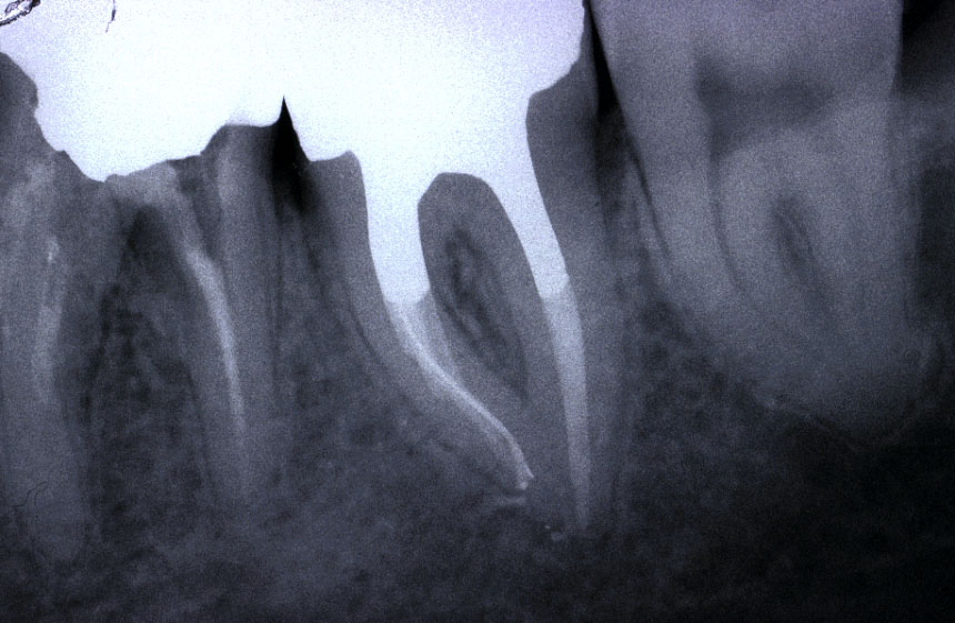Trattamenti endodontici