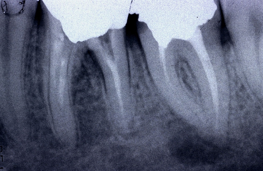 Ritrattamenti endodontici