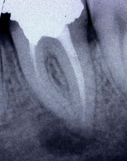 Trattamenti endodontici