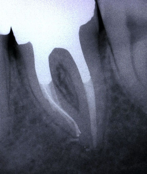 Trattamenti endodontici