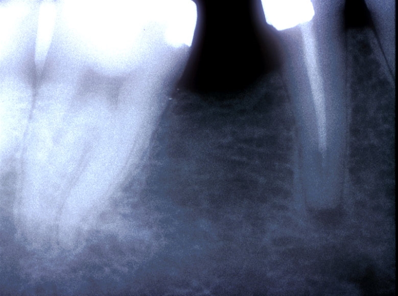 Riassorbimenti