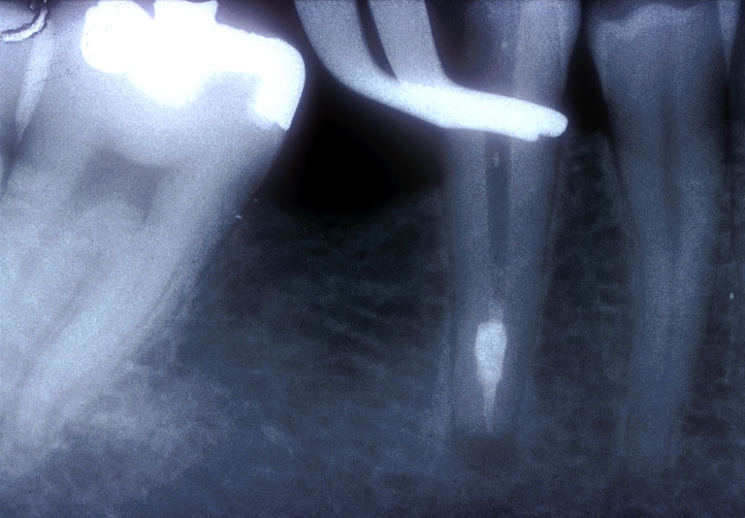 Riassorbimenti
