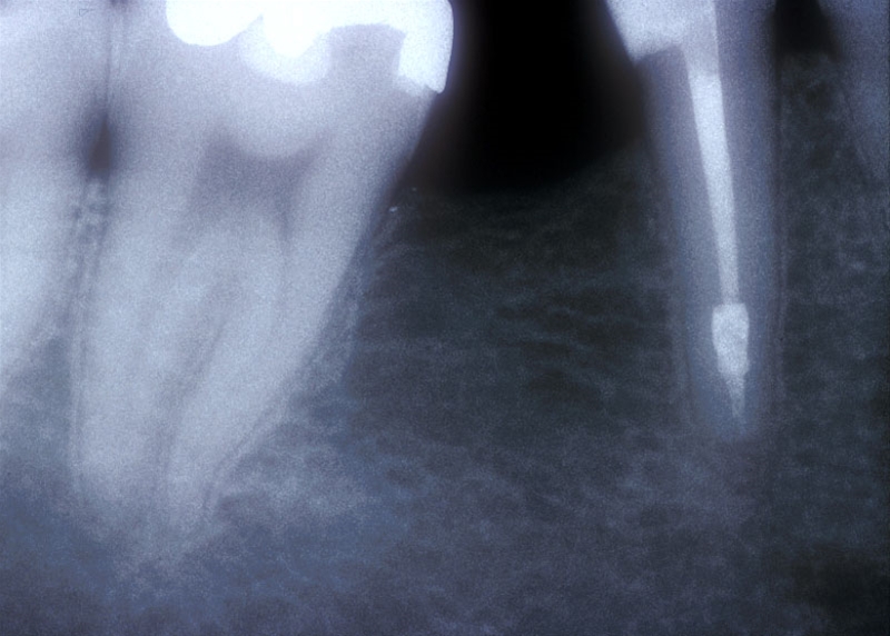 Riassorbimenti