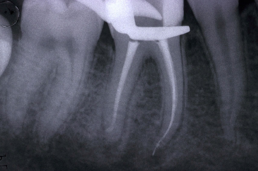 Trattamenti endodontici