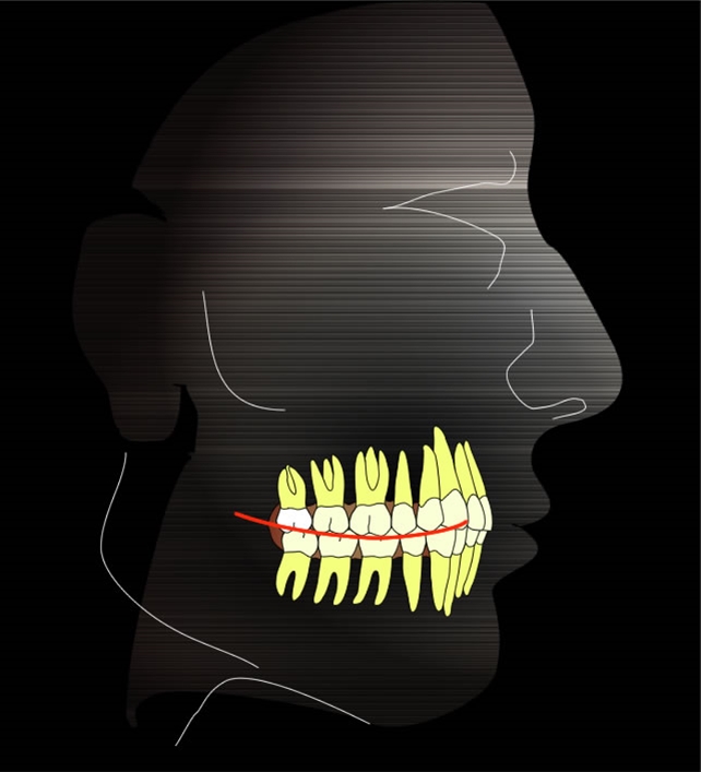 Occlusione